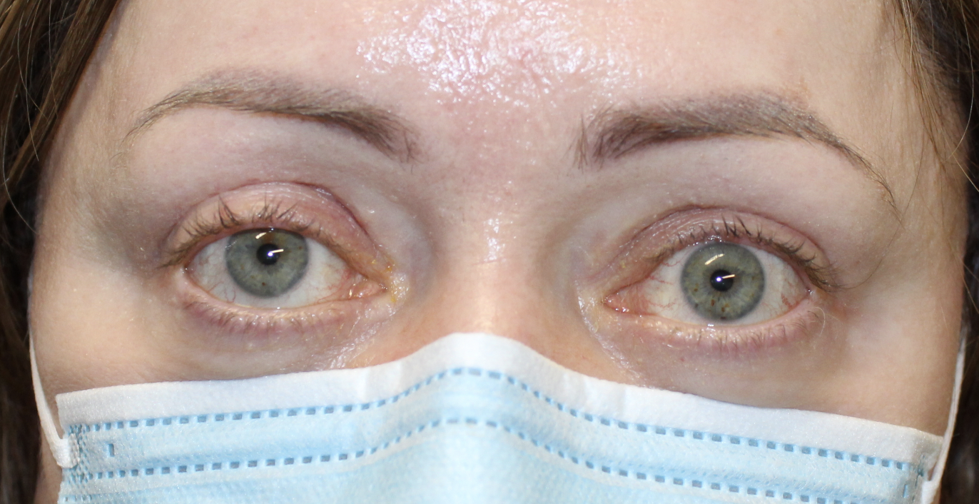 Left Upper Eyelid Retraction Repair Before