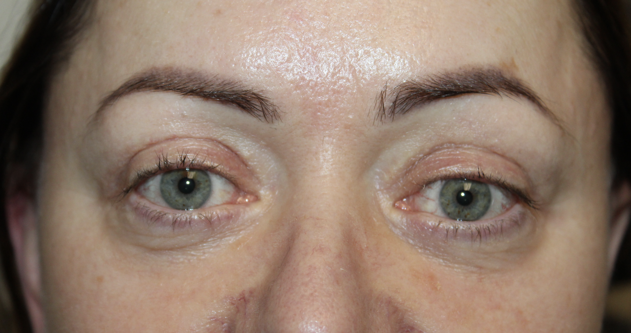 Left Upper Eyelid Retraction Repair After