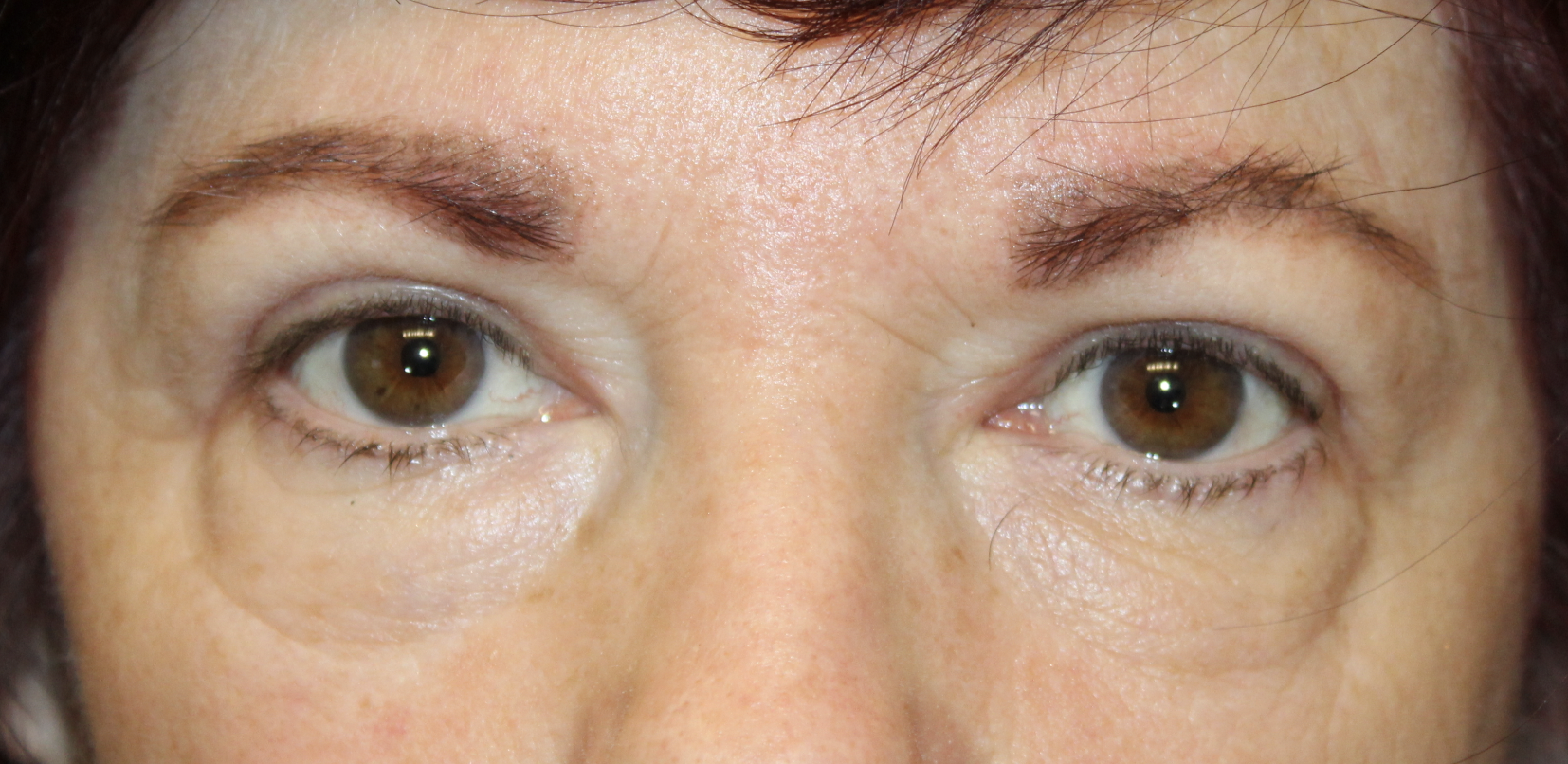 Upper Blepharoplasty After