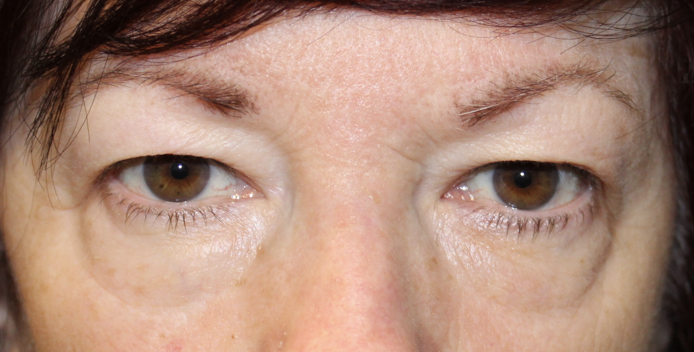 Upper Blepharoplasty Before