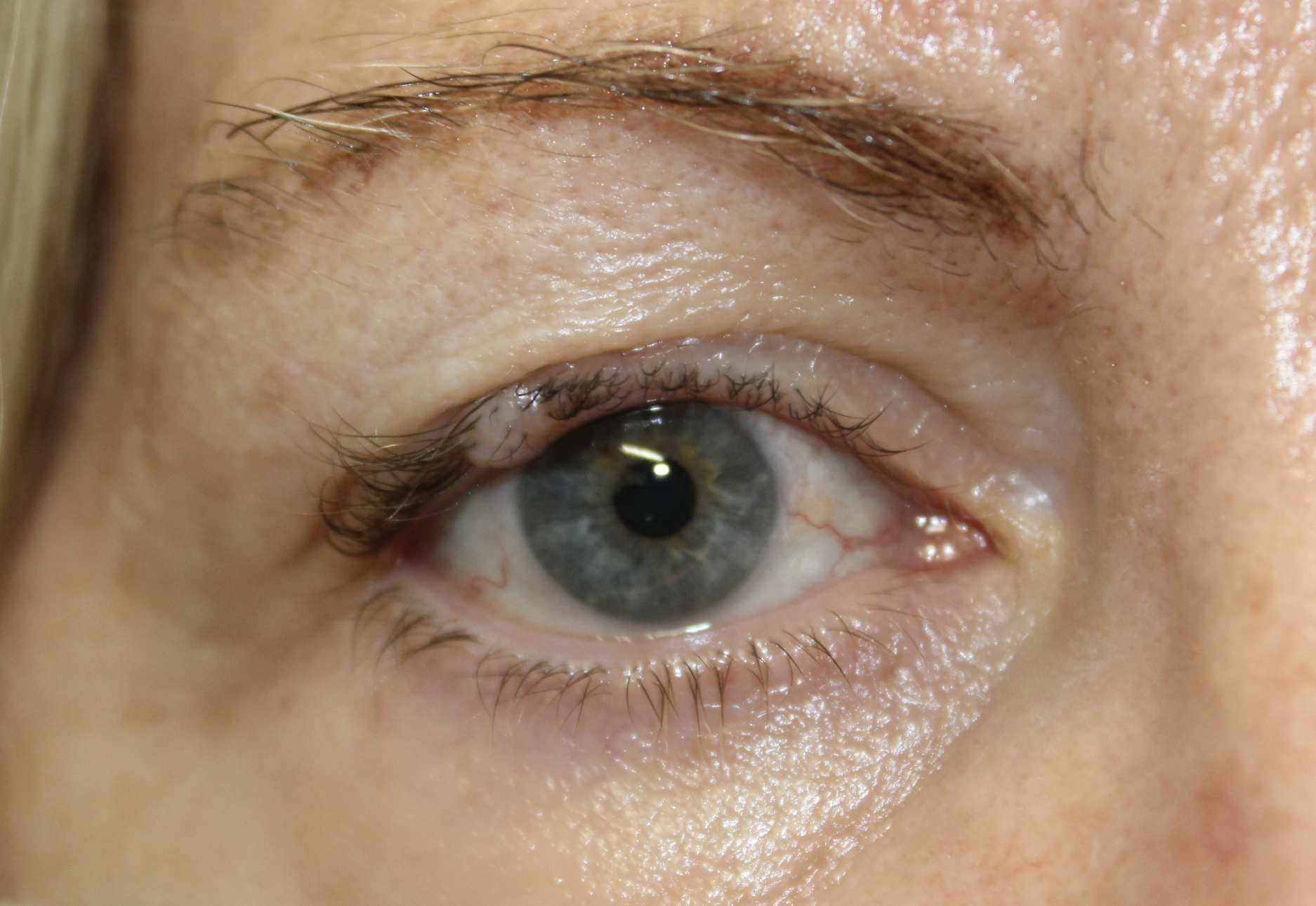 Wedge Removal for Recurrent Mole (Nevus) Before