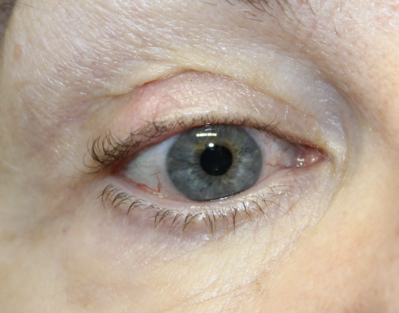 Wedge Removal for Recurrent Mole (Nevus) After