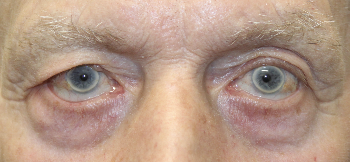 Lower Eyelid Retraction and Ectropion Repaired via Tripier Flap Before