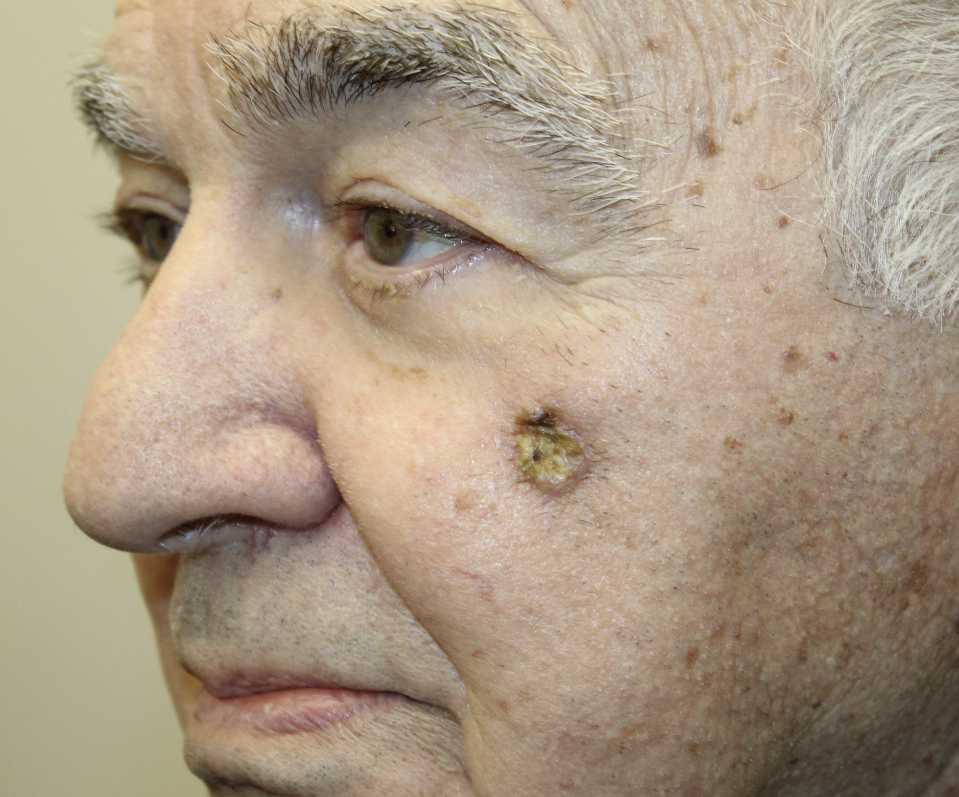 Squamous Cell Carcinoma Before