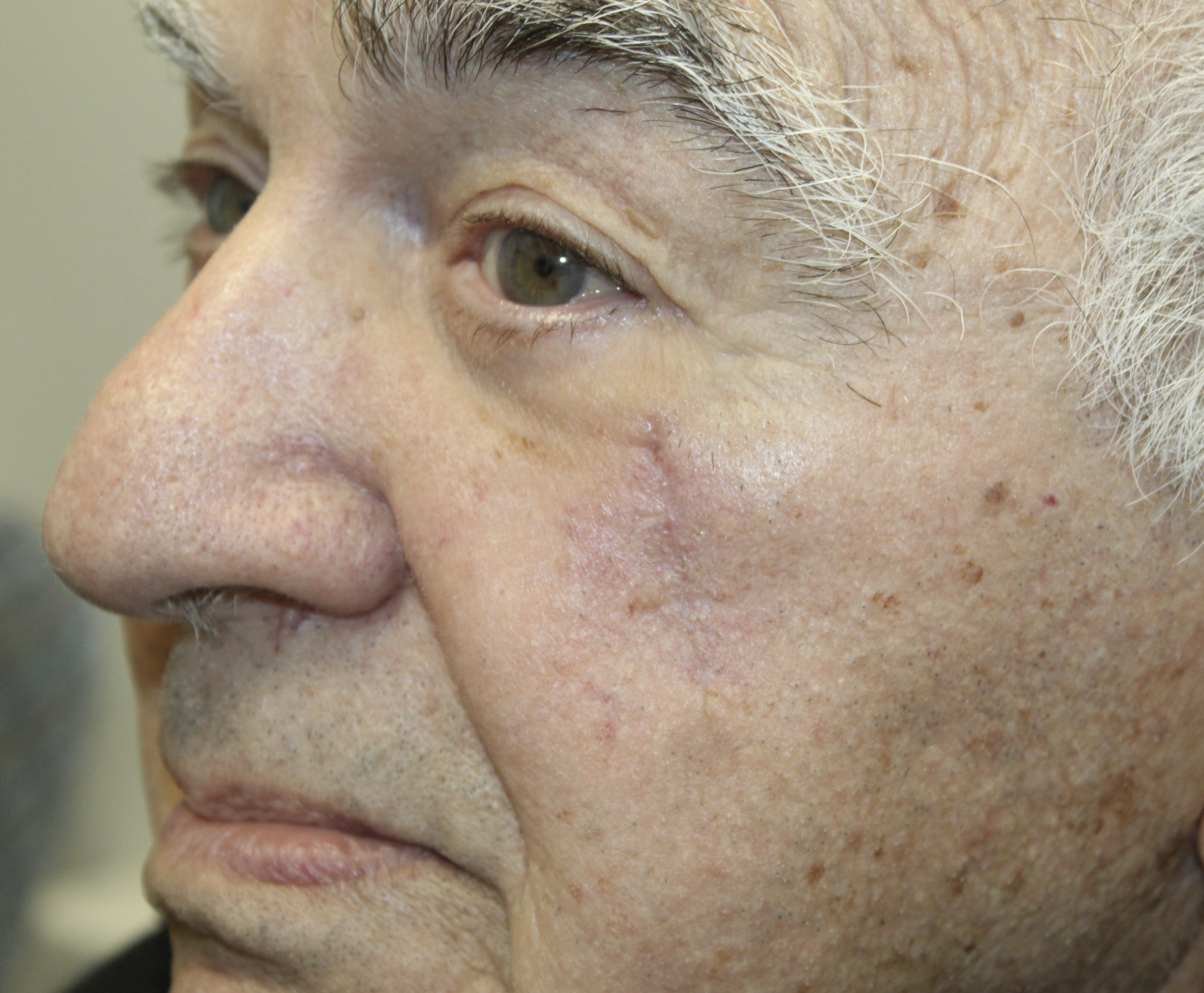 Squamous Cell Carcinoma After