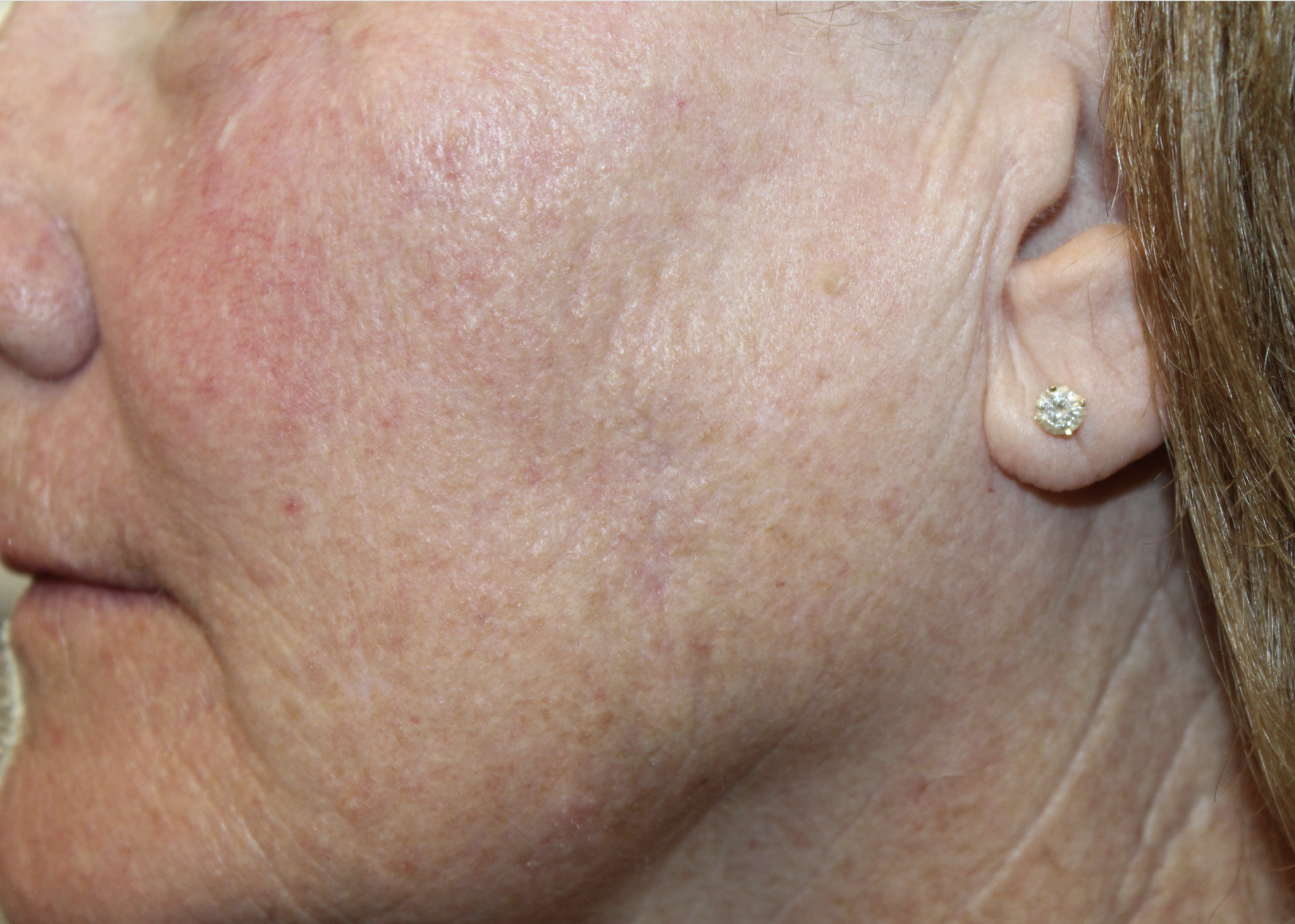 Basal Cell Carcinoma of the Cheek After