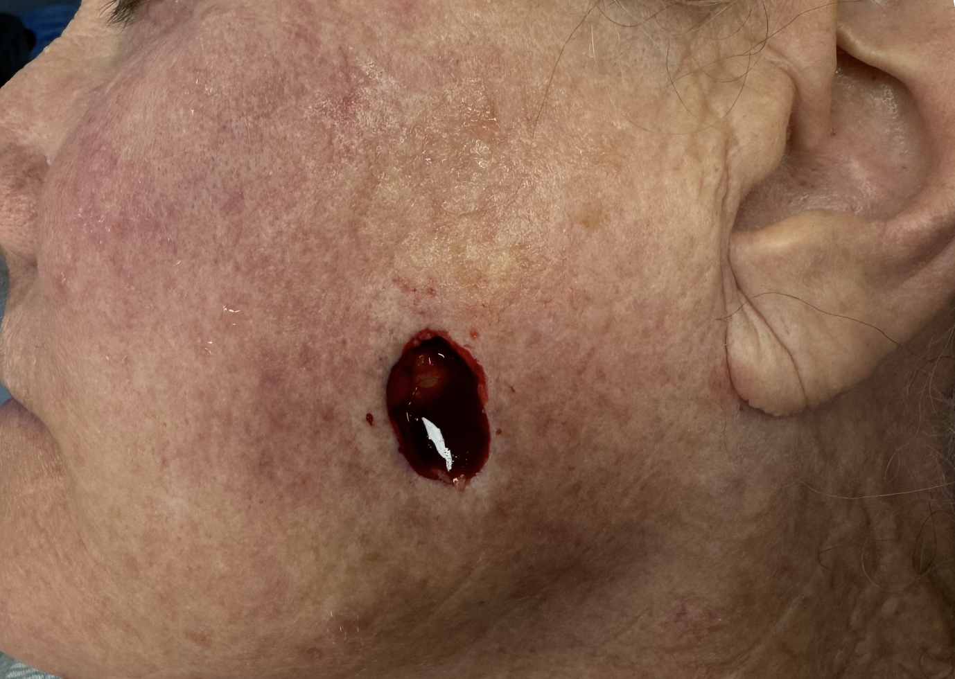 Basal Cell Carcinoma of the Cheek Before