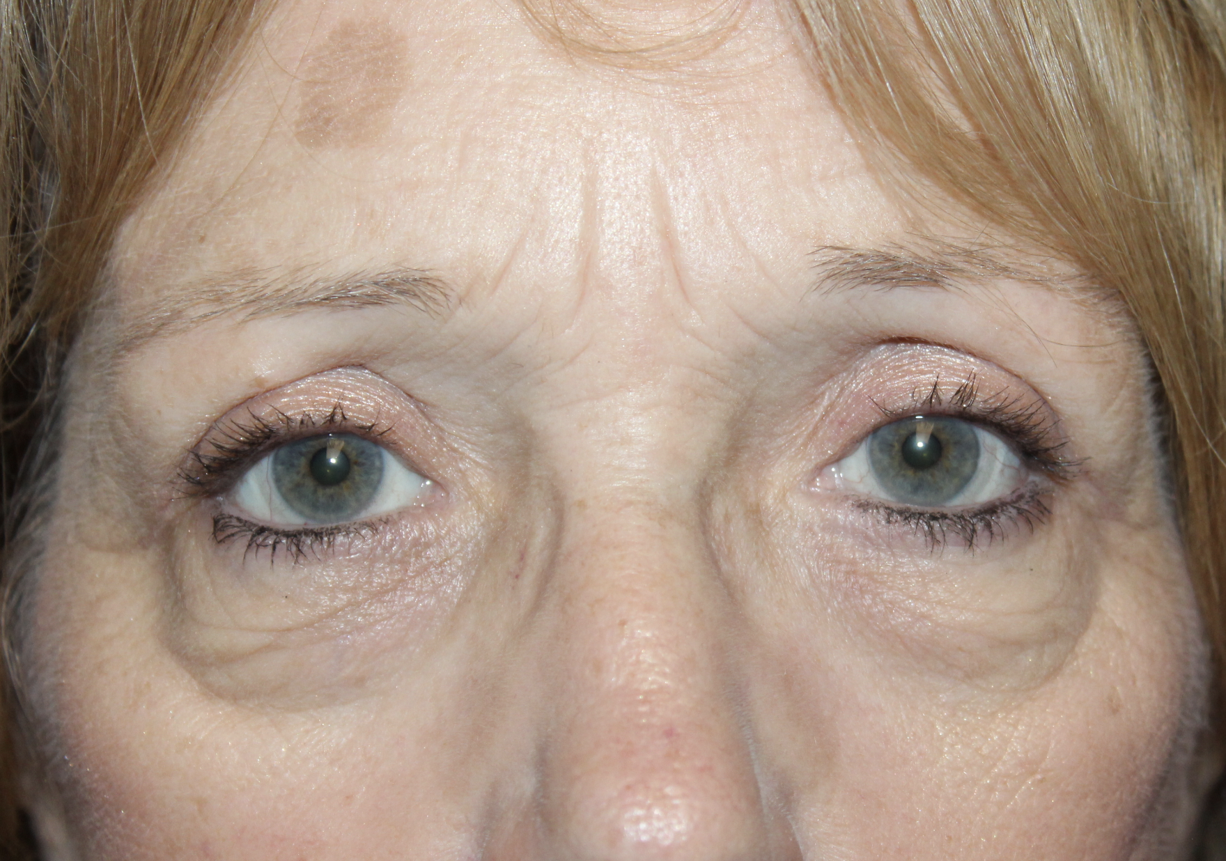 Direct Brow Ptosis Repair and Upper Blepharoplasty After