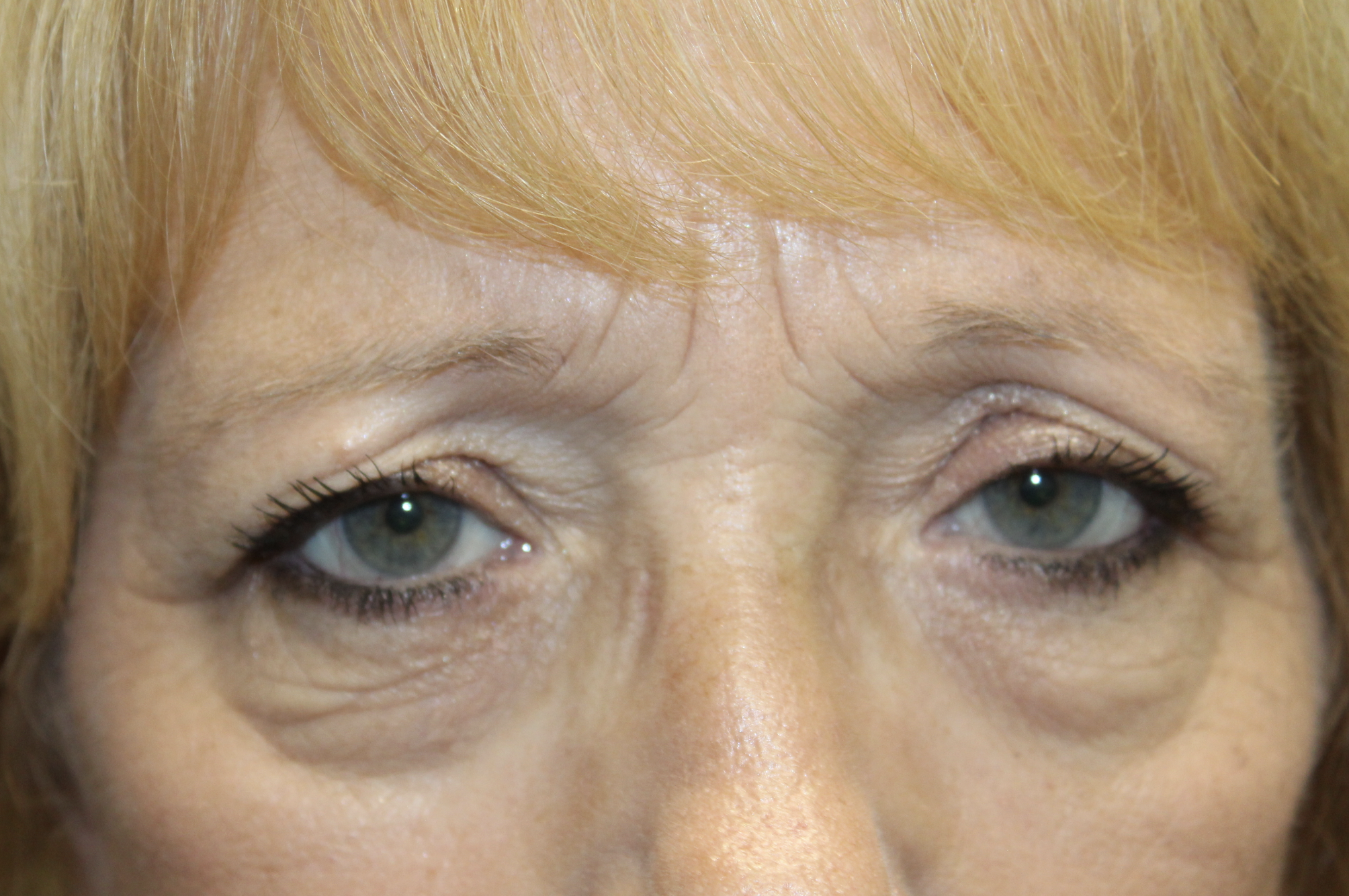 Direct Brow Ptosis Repair and Upper Blepharoplasty Before
