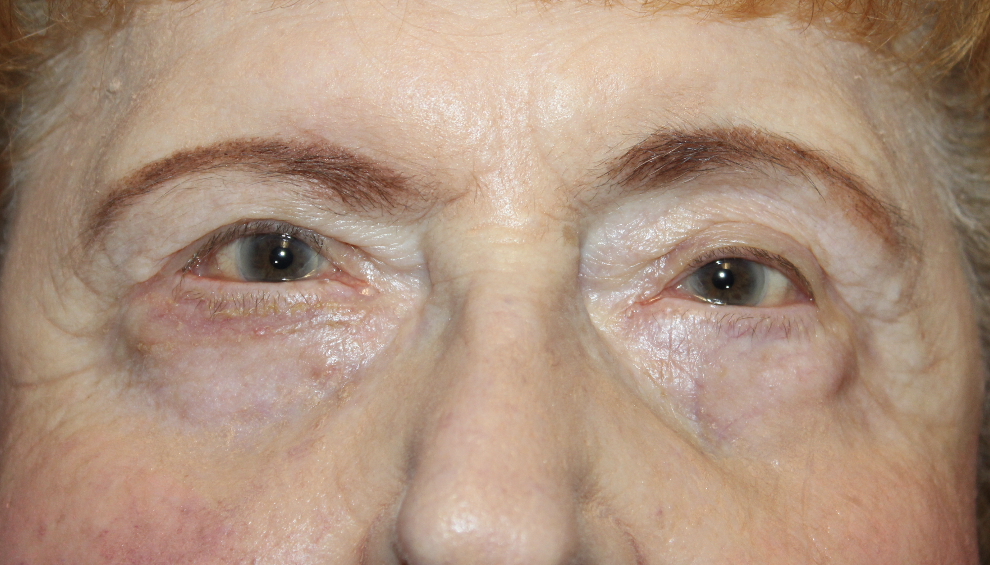 Ectropion Repair using a Tripier Flap After