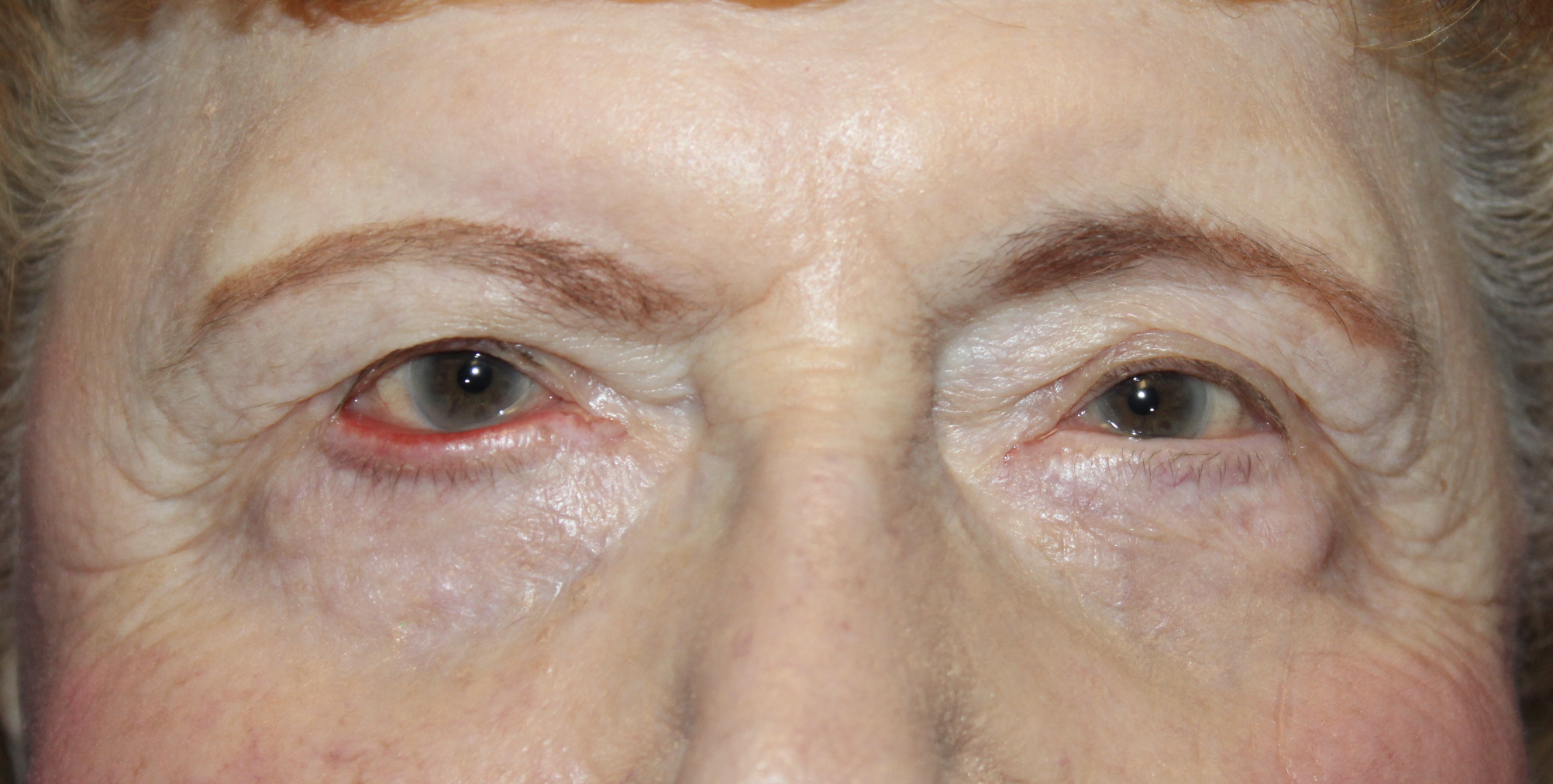 Ectropion Repair using a Tripier Flap Before