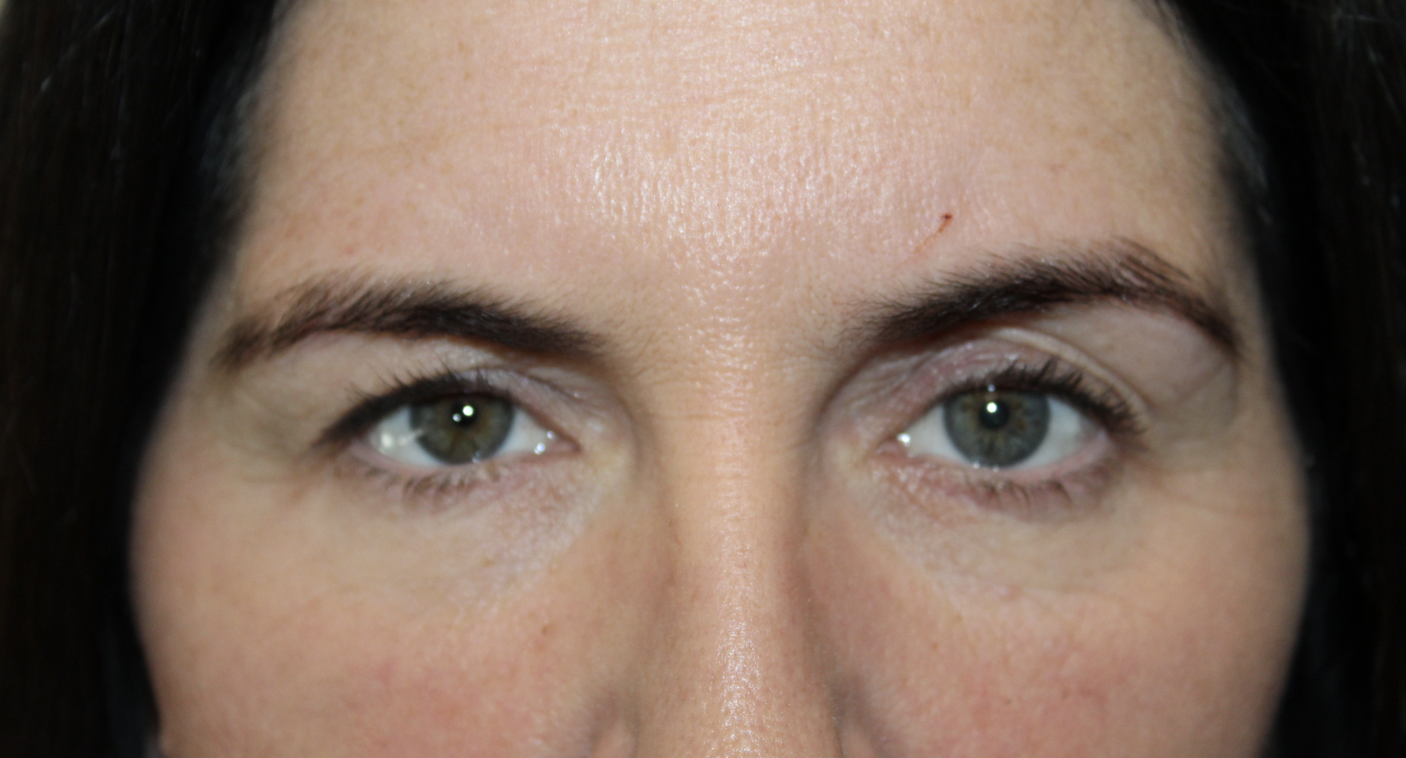 pretrichial brow lift on both sides and upper blepharoplasty of the right side. Before