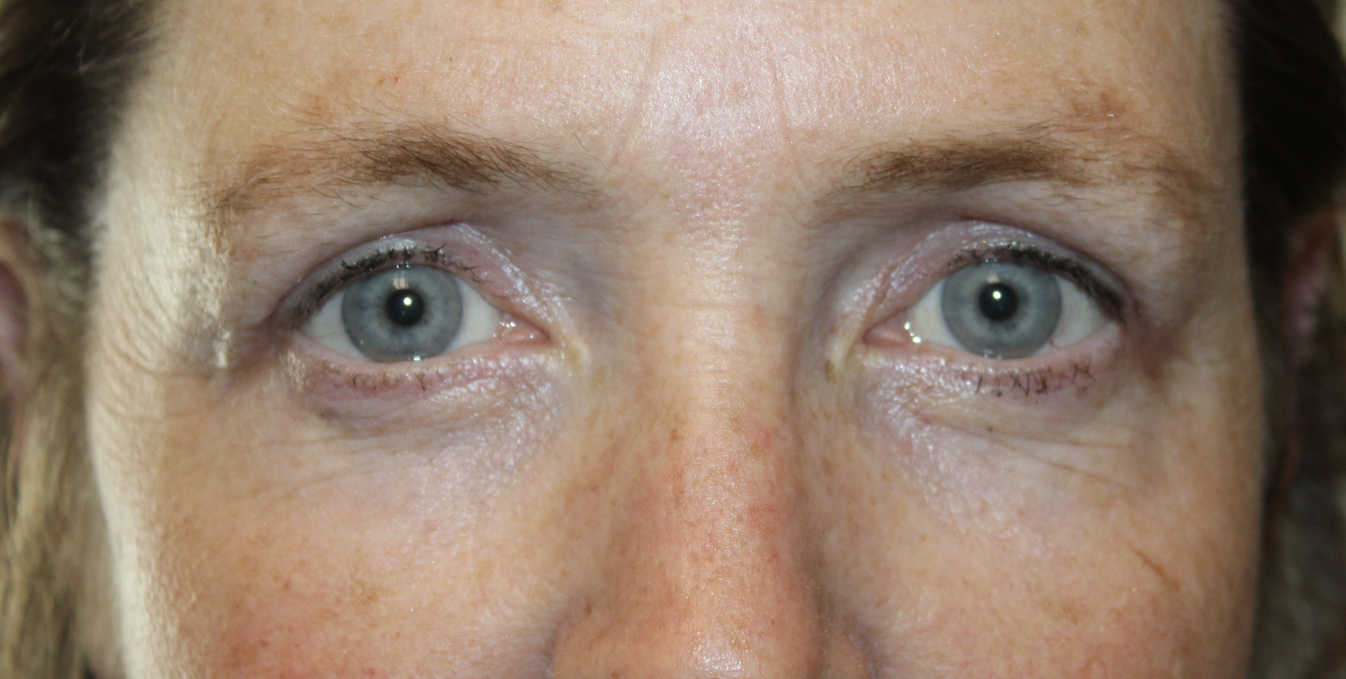 Upper and Lower Blepharoplasty with TCA Peel and Canthopexy After