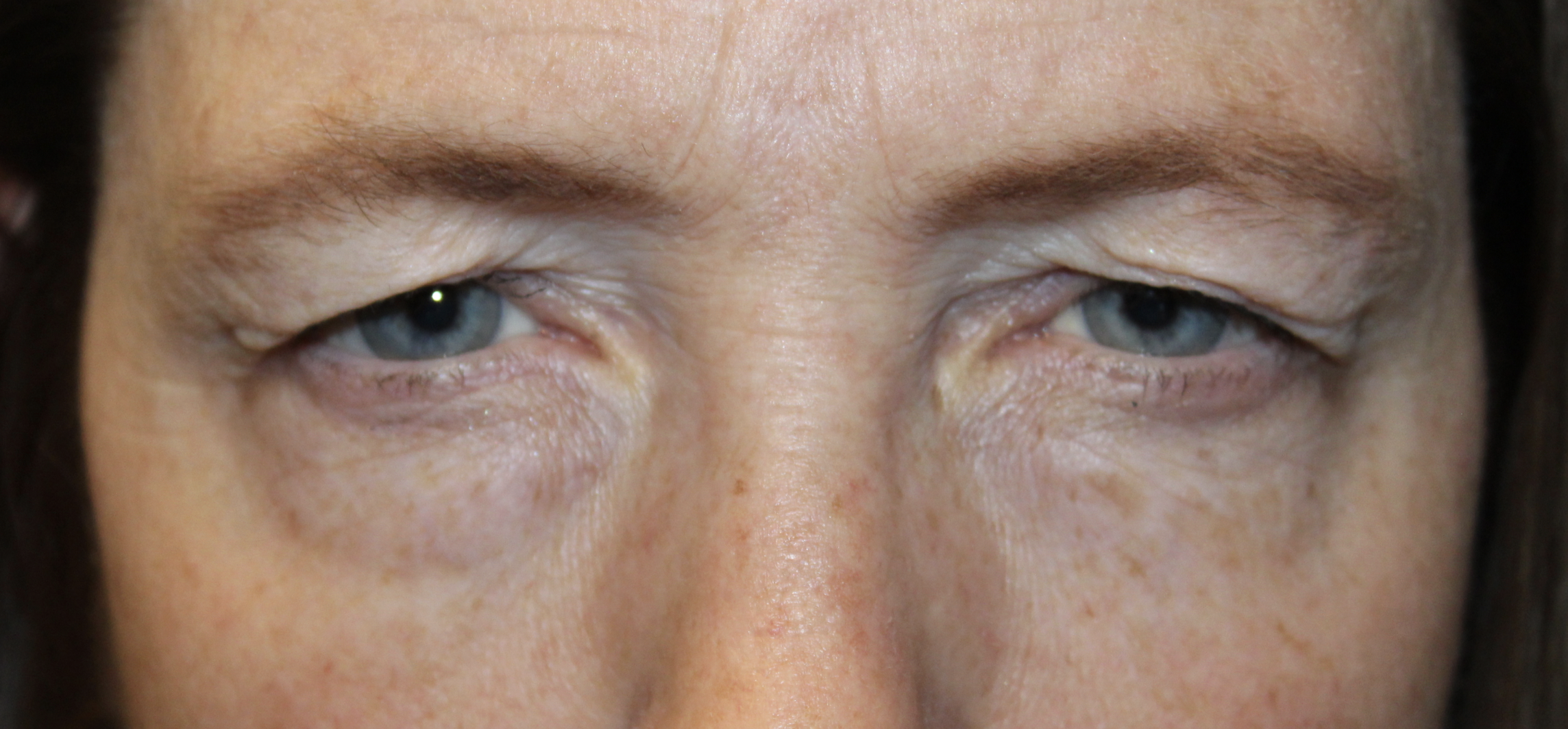 Upper and Lower Blepharoplasty with TCA Peel and Canthopexy Before