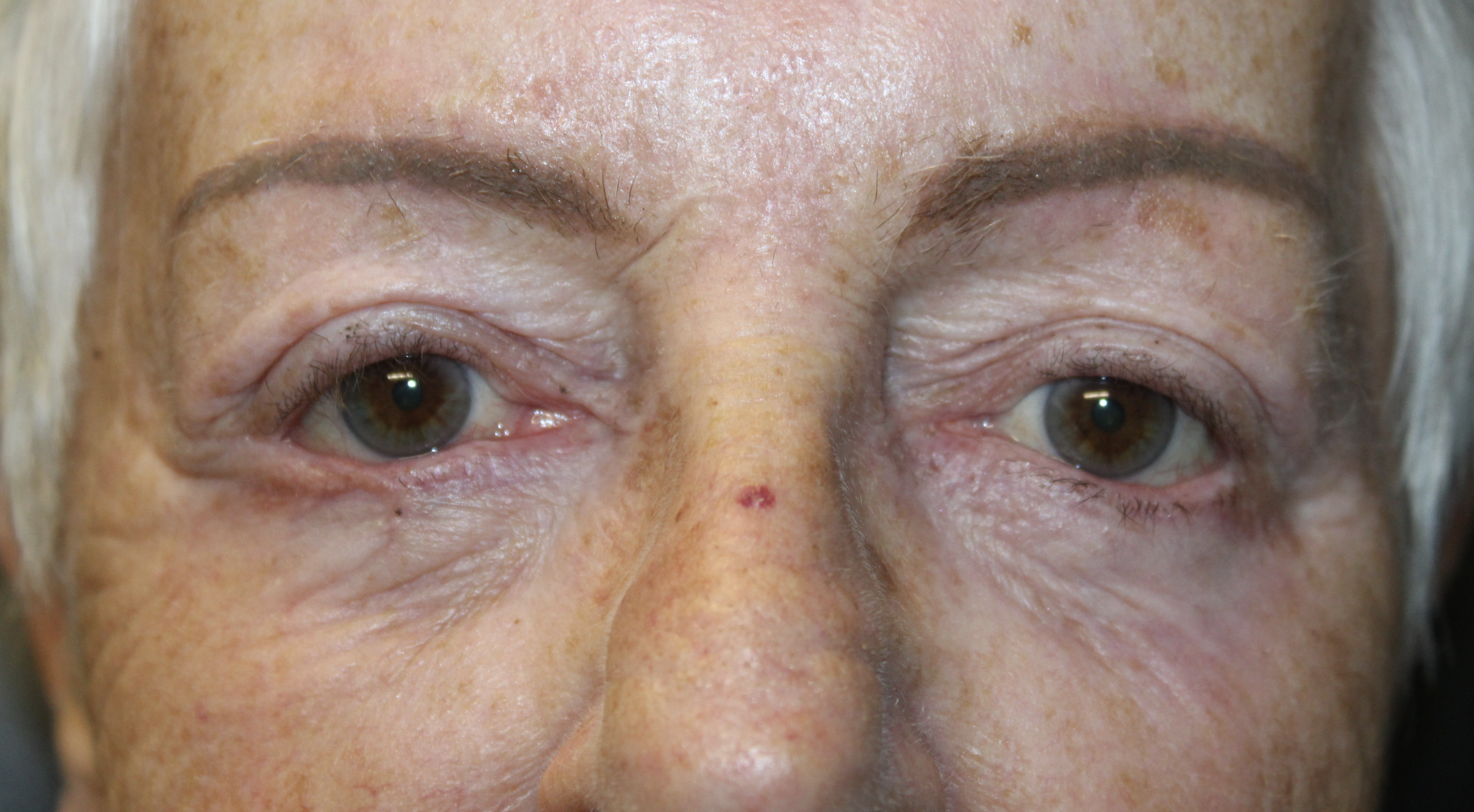 Combination of Tenzel and Tripier Flaps After