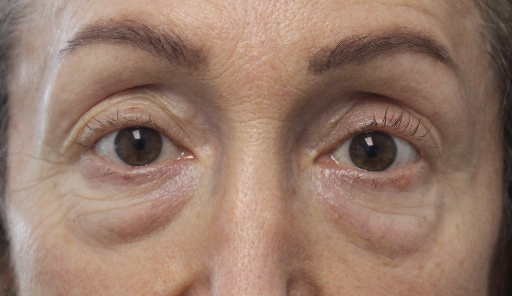 Lower Blepharoplasty and TCA Peel Before