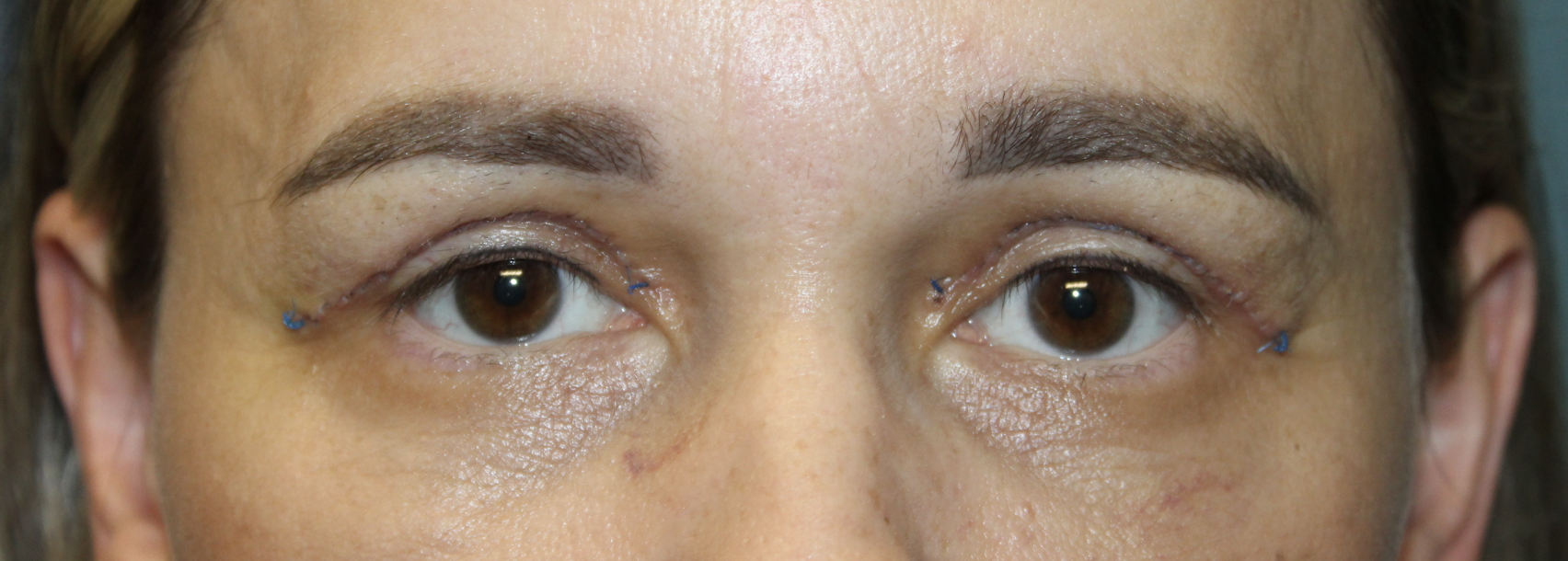Upper Blepharoplasty After