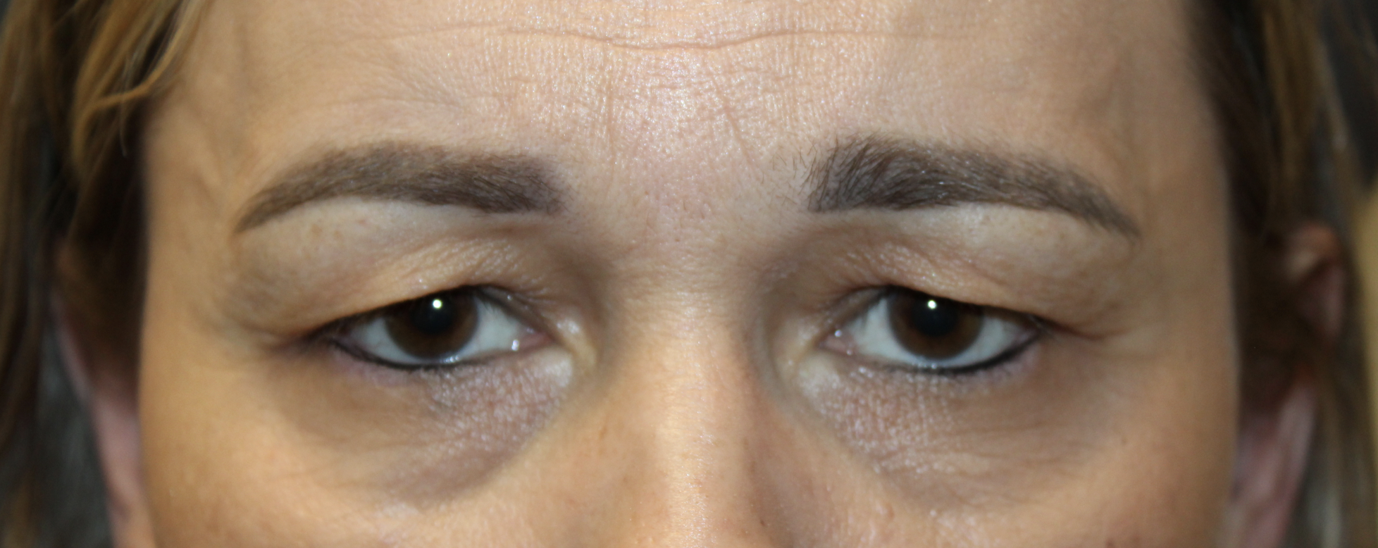 Upper Blepharoplasty Before