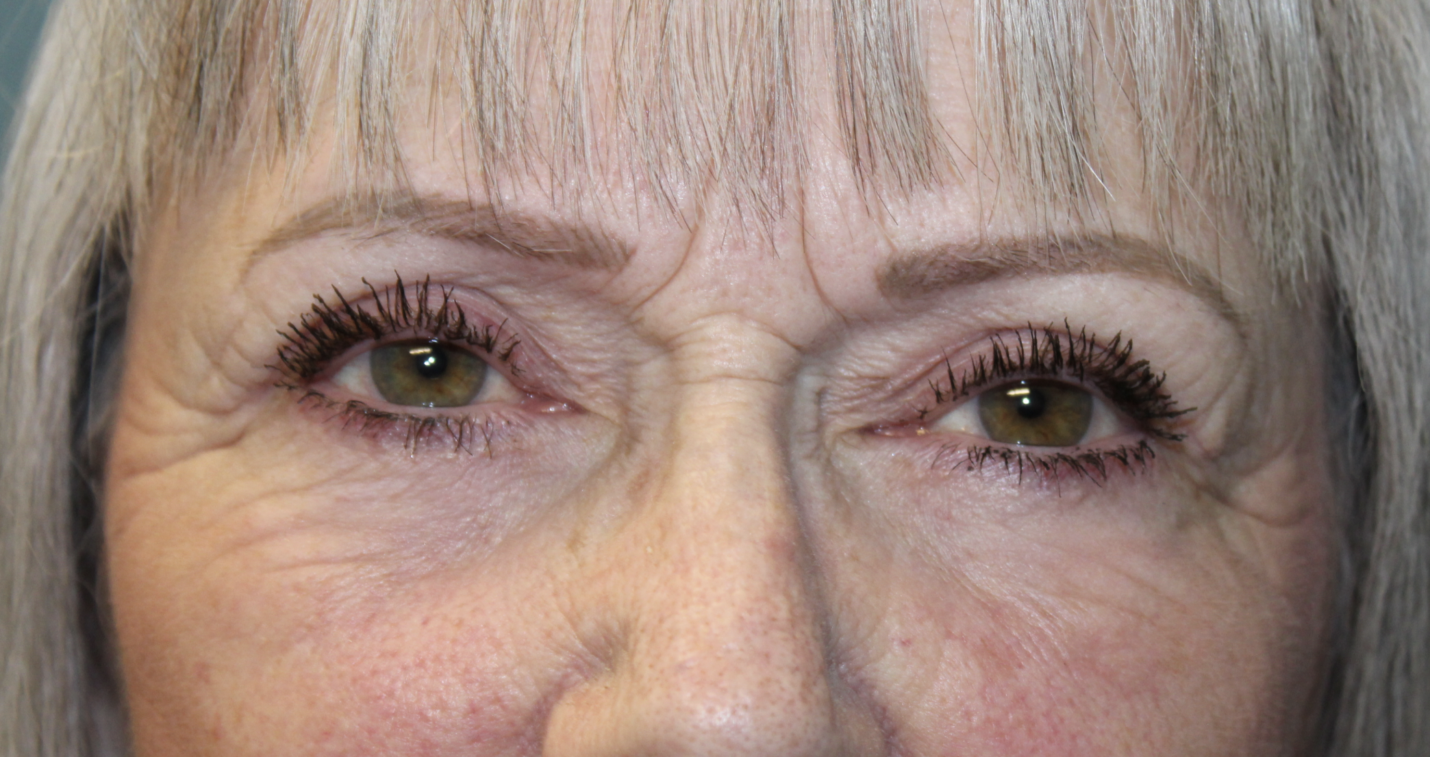 Upper and Lower Blepharoplasty with TCA Peel and Canthopexy After