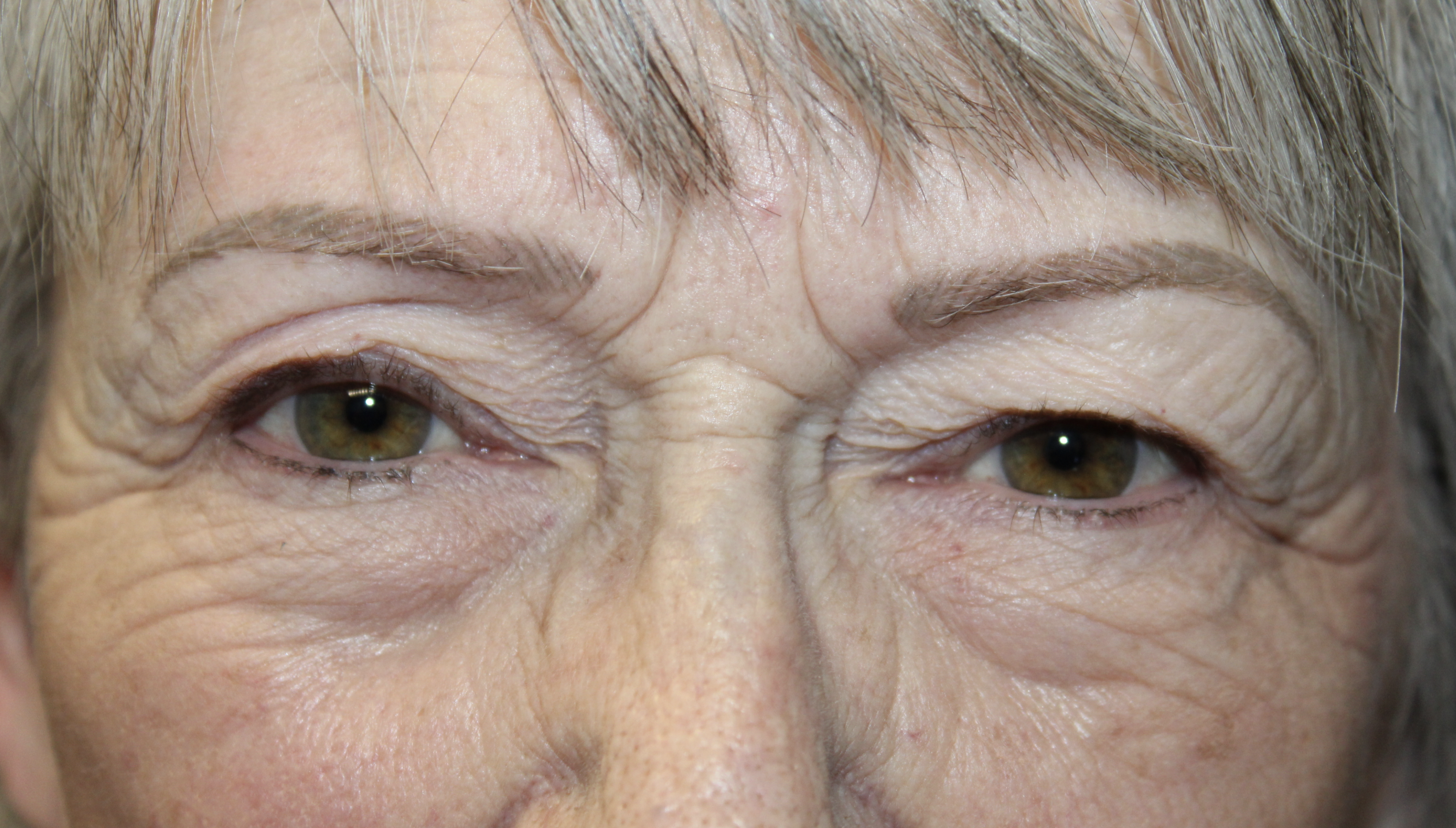 Upper and Lower Blepharoplasty with TCA Peel and Canthopexy Before