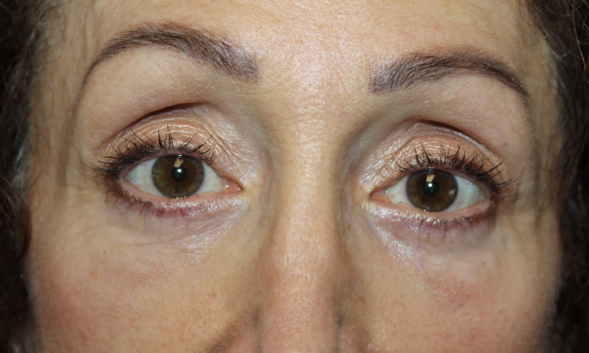 Lower Blepharoplasty and TCA Peel After