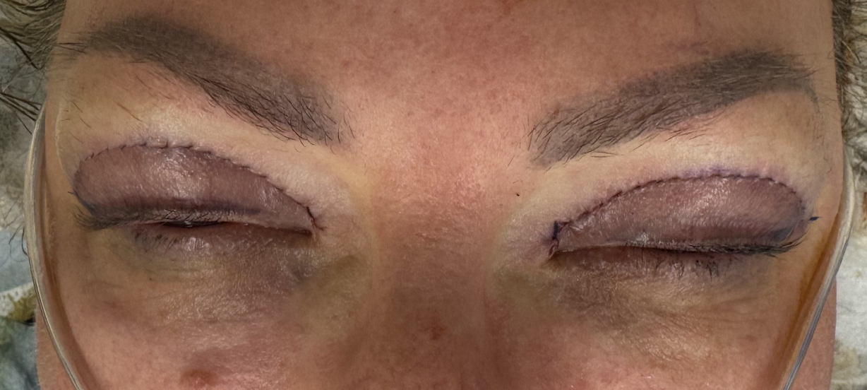 Suturing for Upper Blepharoplasty After