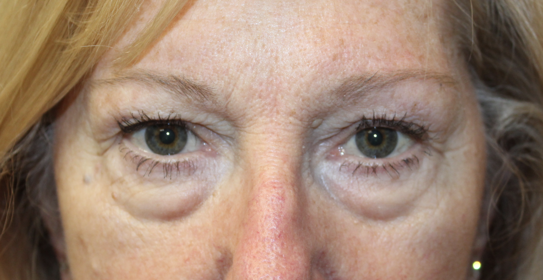 Upper and Lower Eyelid Blepharoplasty with TCA Peel Before