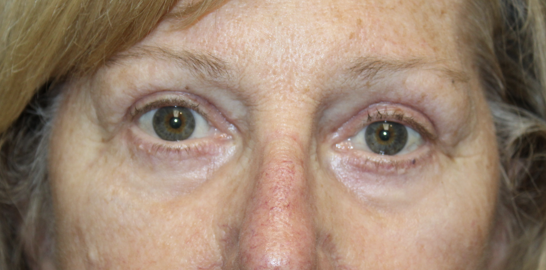 Upper and Lower Eyelid Blepharoplasty with TCA Peel After