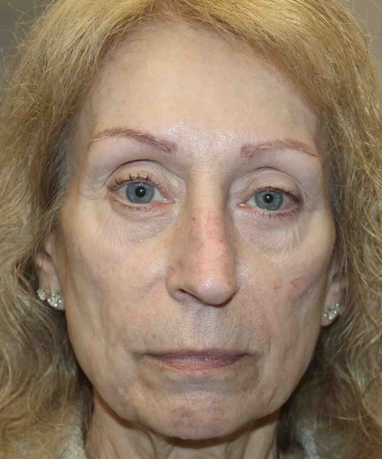 Sculptra Before