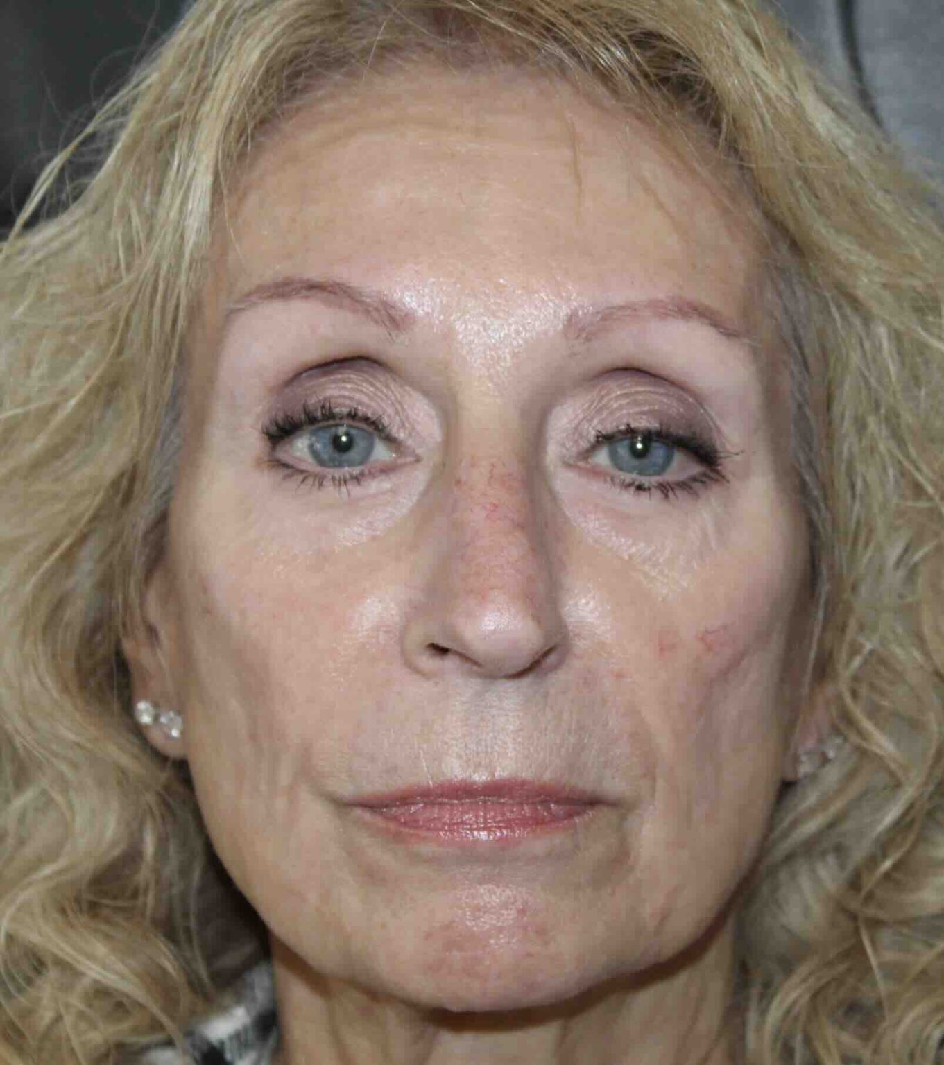 Sculptra After