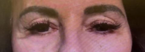 Lid Ptosis & Brow Ptosis Surgery Before