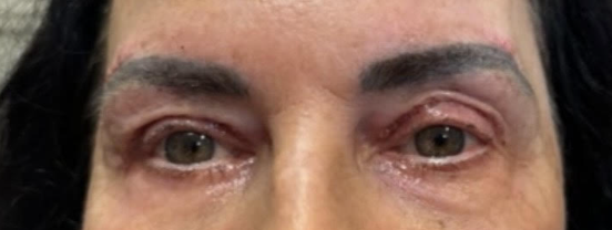 Lid Ptosis & Brow Ptosis Surgery After