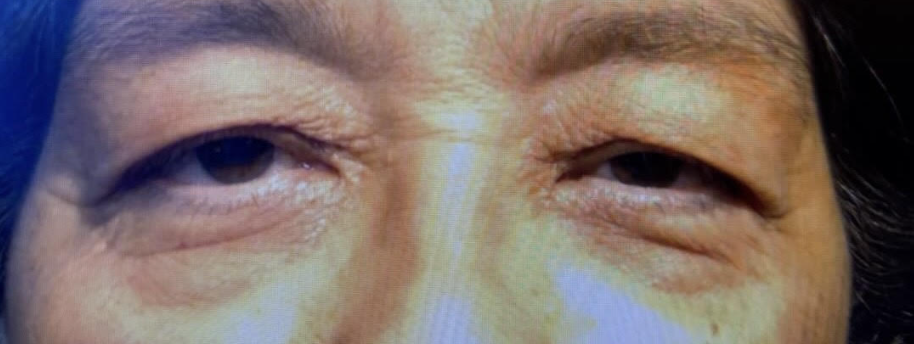 Lid Ptosis & Brow Ptosis Surgery Before