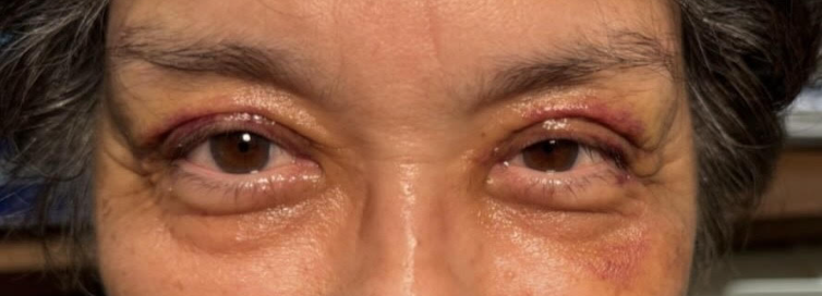 Lid Ptosis & Brow Ptosis Surgery After
