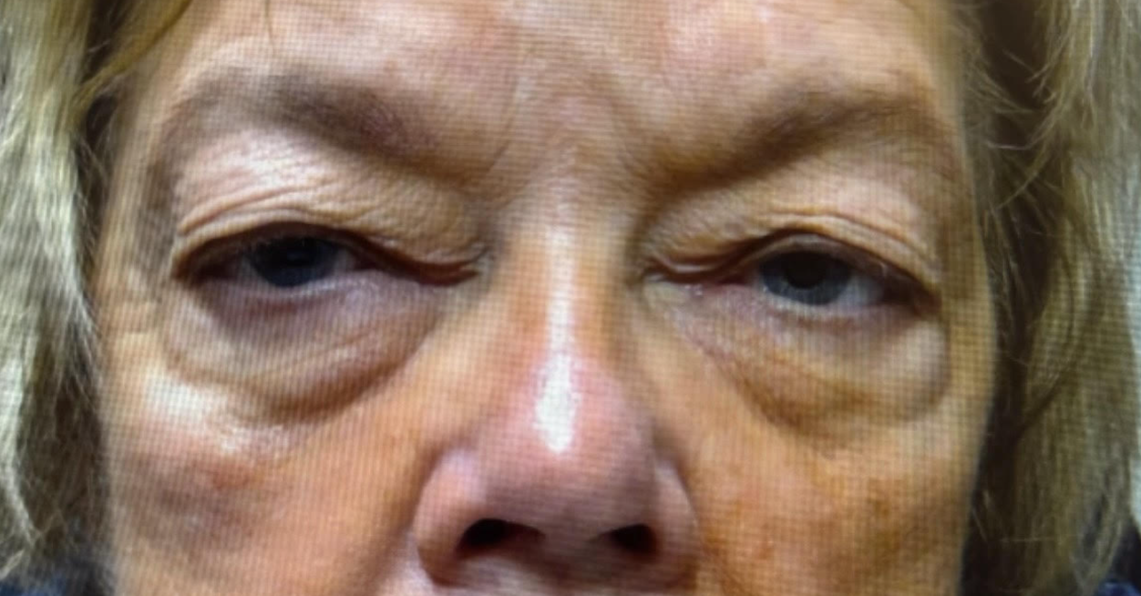 Lid Ptosis & Brow Ptosis Surgery Before
