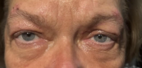 Lid Ptosis & Brow Ptosis Surgery After