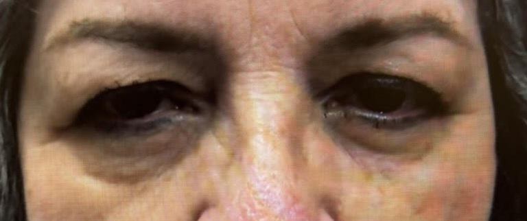 Lid Ptosis & Brow Ptosis Surgery Before