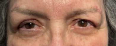 Lid Ptosis & Brow Ptosis Surgery After
