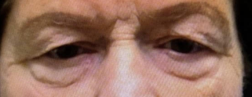 Lid Ptosis & Brow Ptosis Surgery Before
