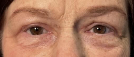 Lid Ptosis & Brow Ptosis Surgery After