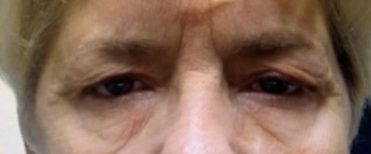 Lid Ptosis & Brow Ptosis Surgery Before