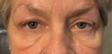 Lid Ptosis & Brow Ptosis Surgery After