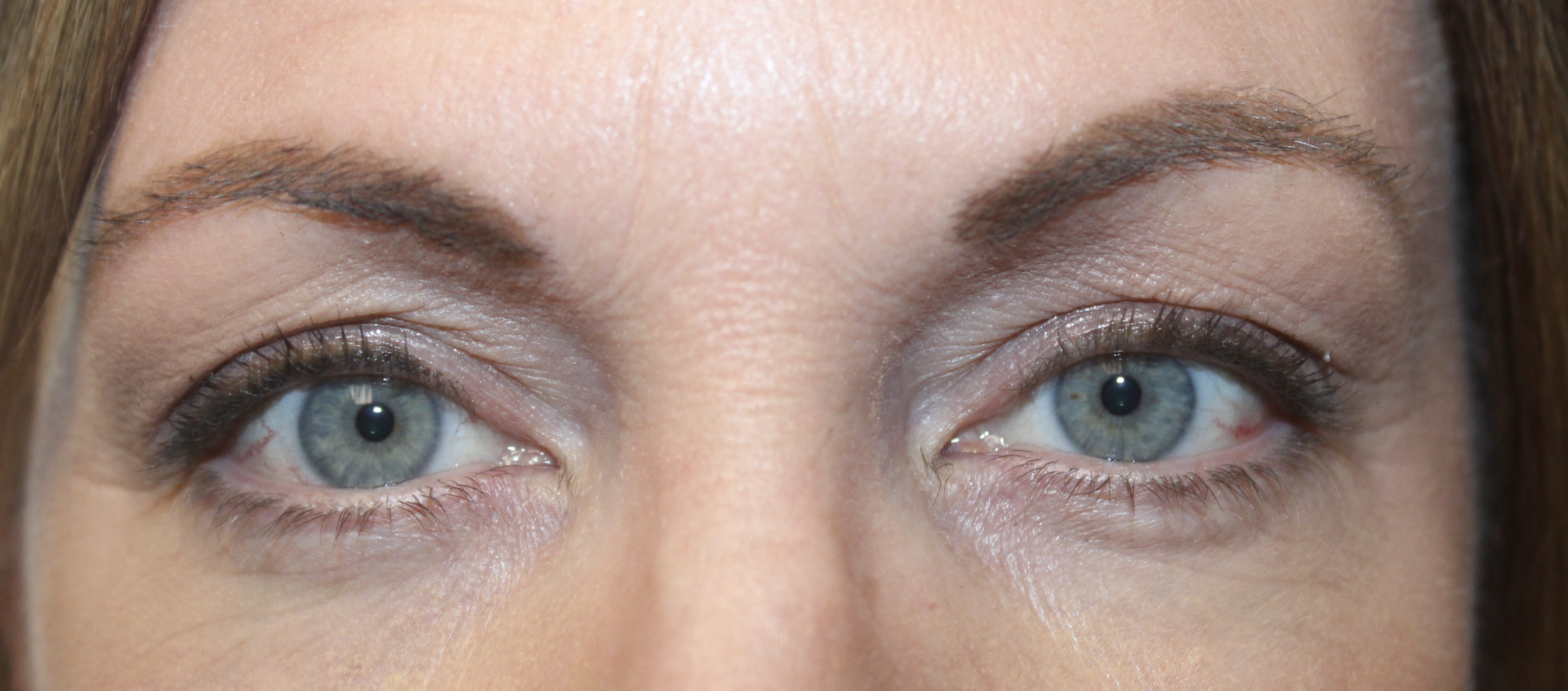 Ptosis Repair to Lift Droopy Eyelid After