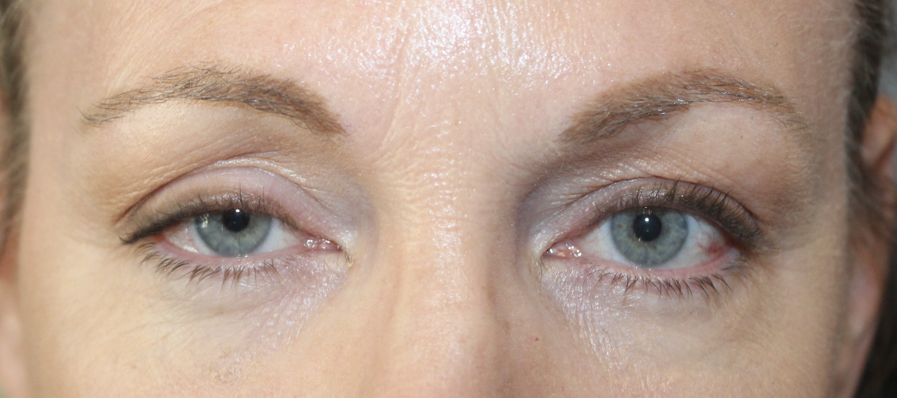 Ptosis Repair to Lift Droopy Eyelid Before