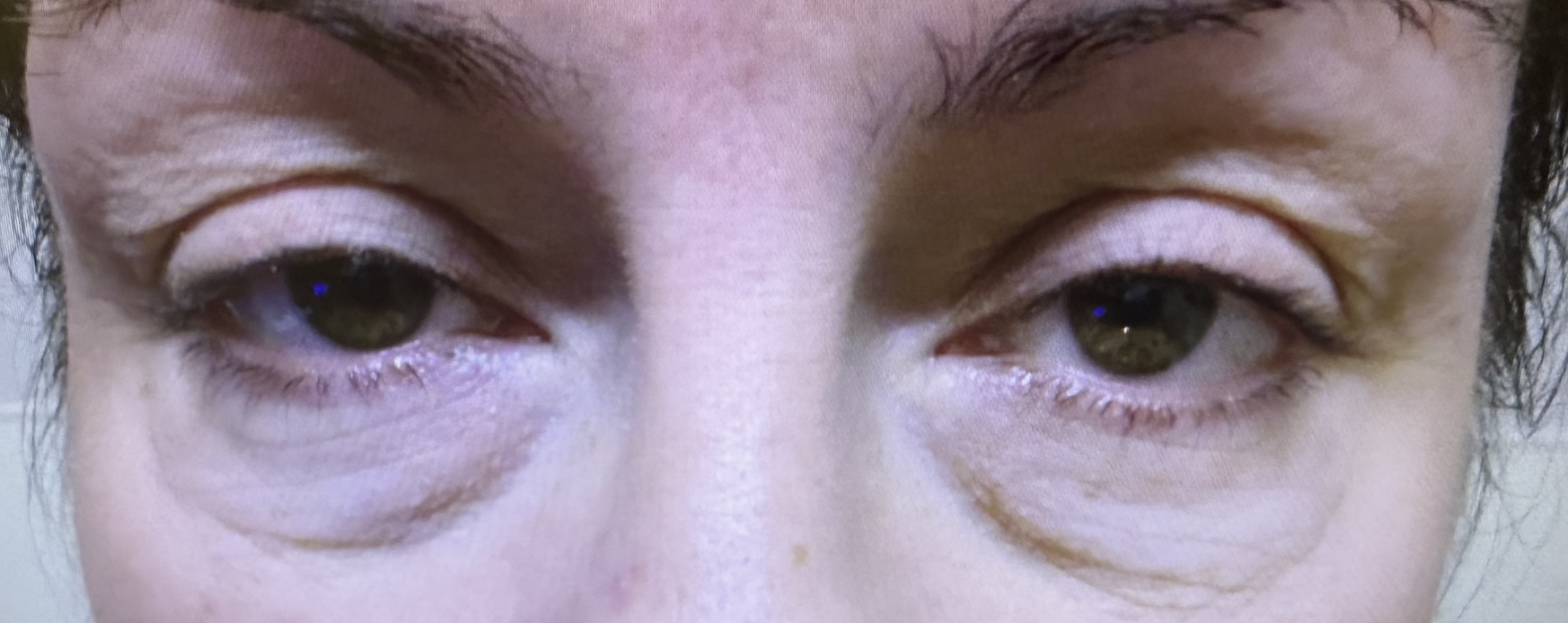 Upper and Lower Eyelid Cosmetic Blepharoplasty and Brow Lift Both Eyes Before