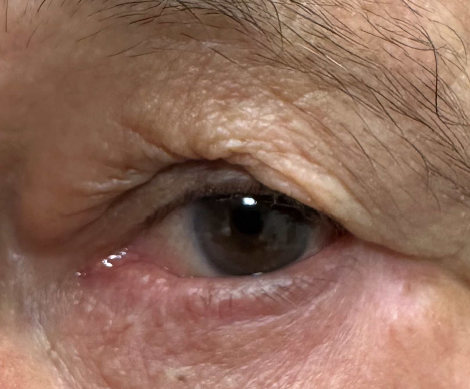 Entropion Repair After