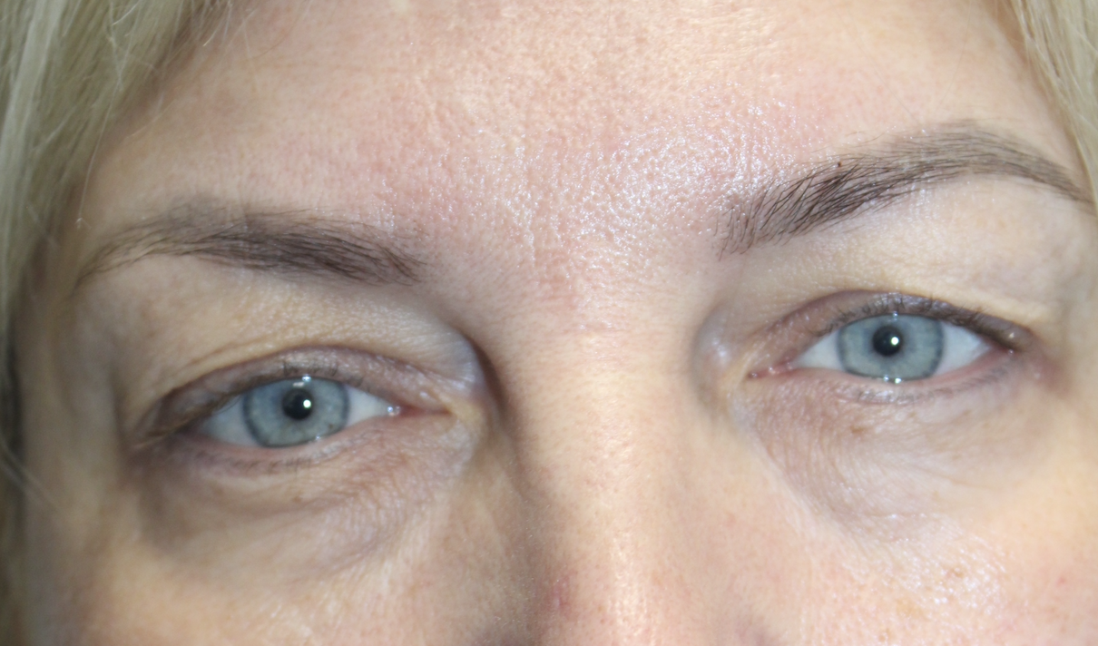 Bilateral Upper Blepharoplasty Before
