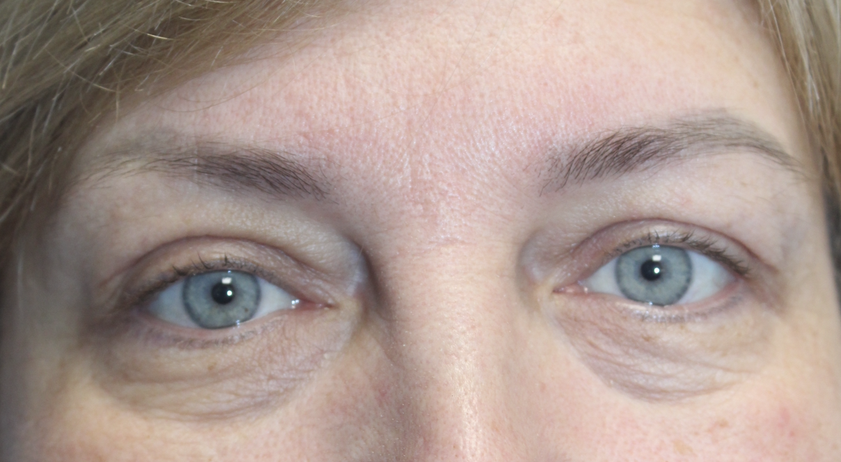 Bilateral Upper Blepharoplasty After
