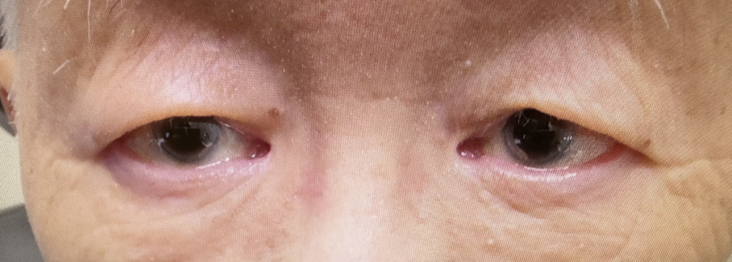 Asian Blepharoplasty (Westernization ) Before