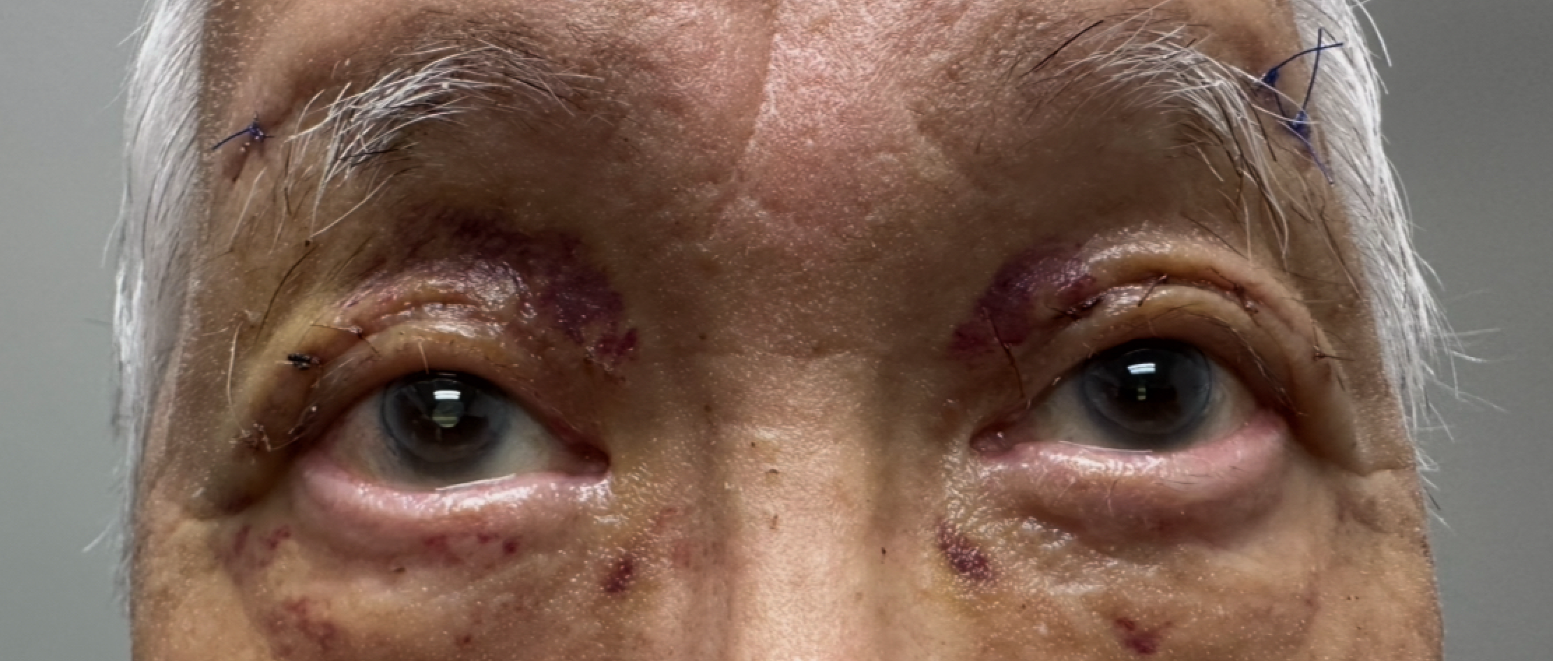 Asian Blepharoplasty (Westernization ) After